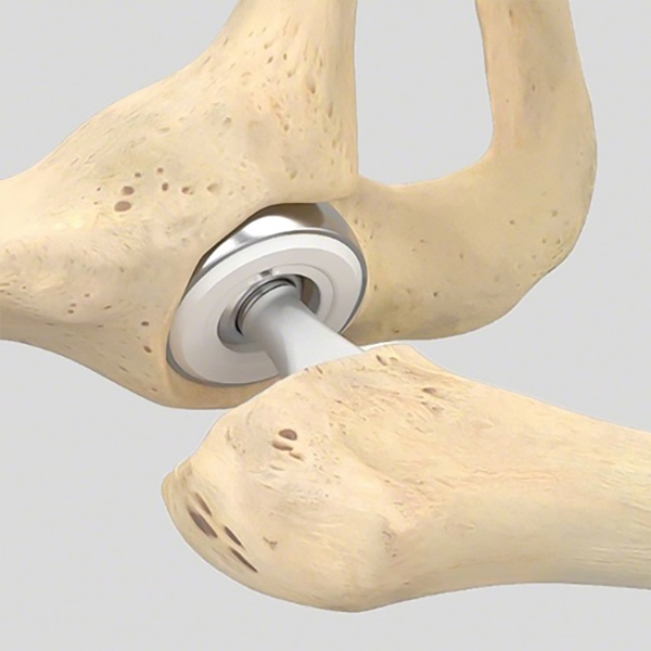 پروتز بایپولار